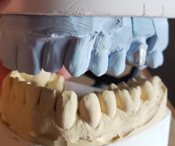 My First Root&nbsp;Canal